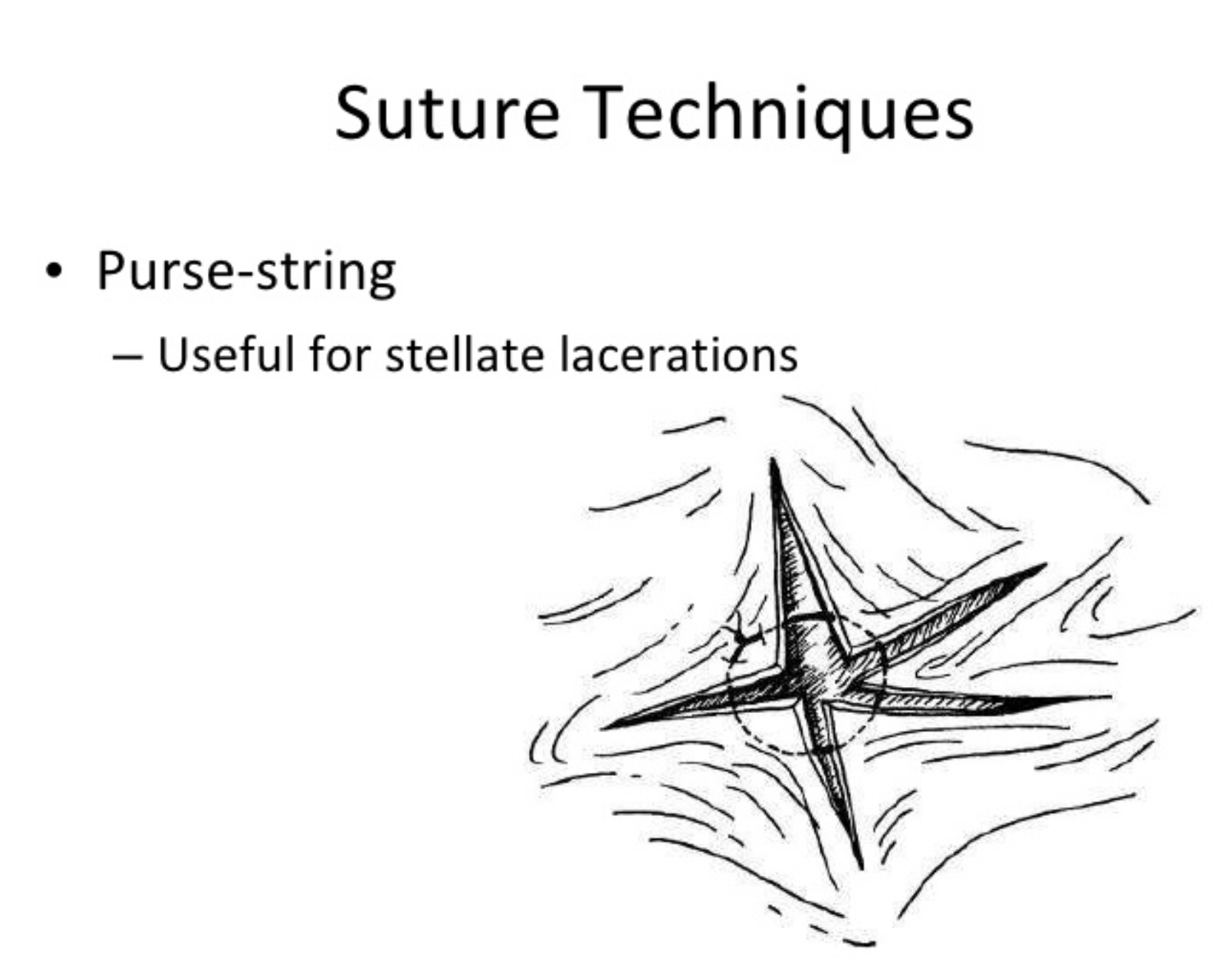 Dealing with triangle puncture wounds ECHEMI