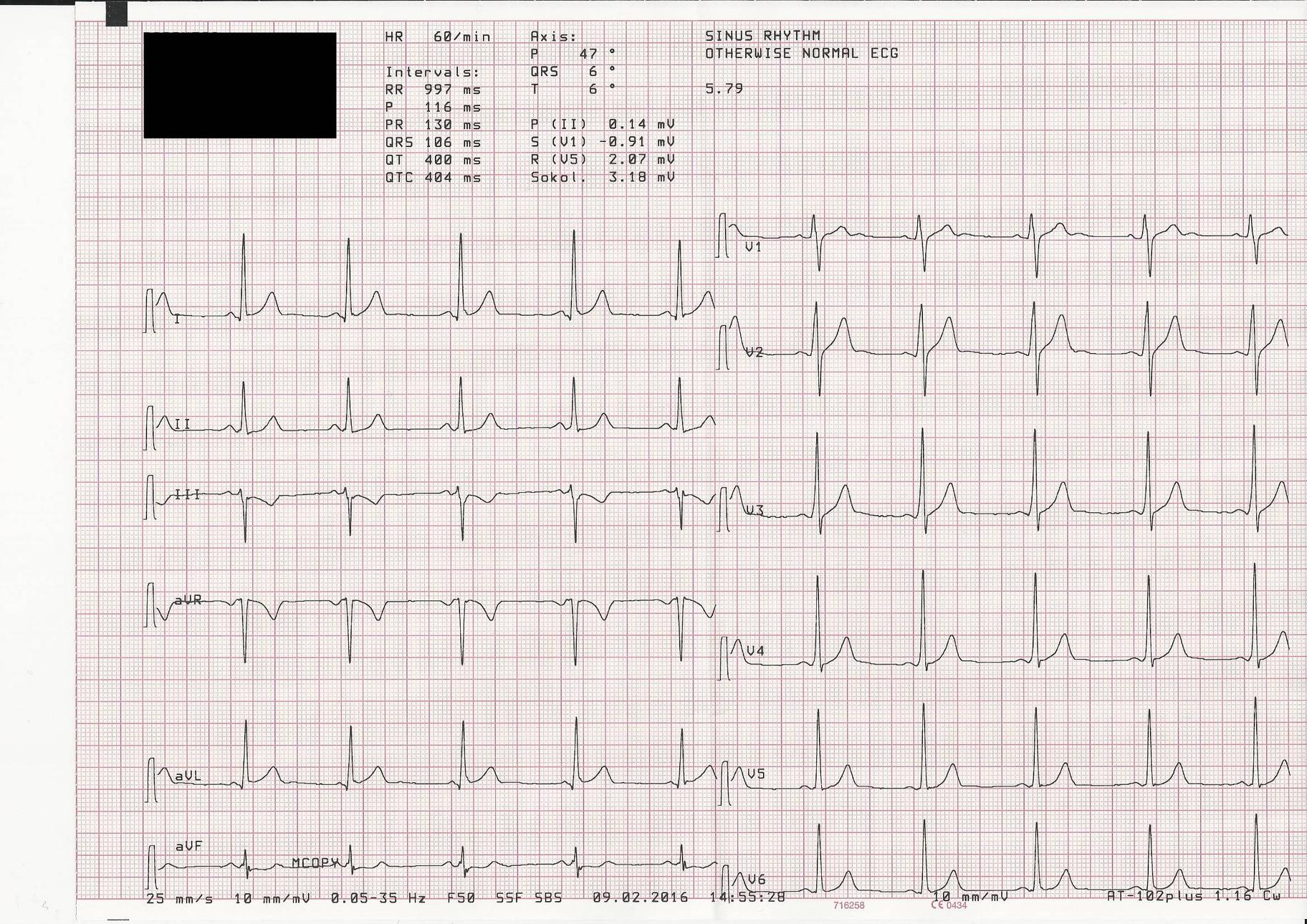 electrocardiograma normal