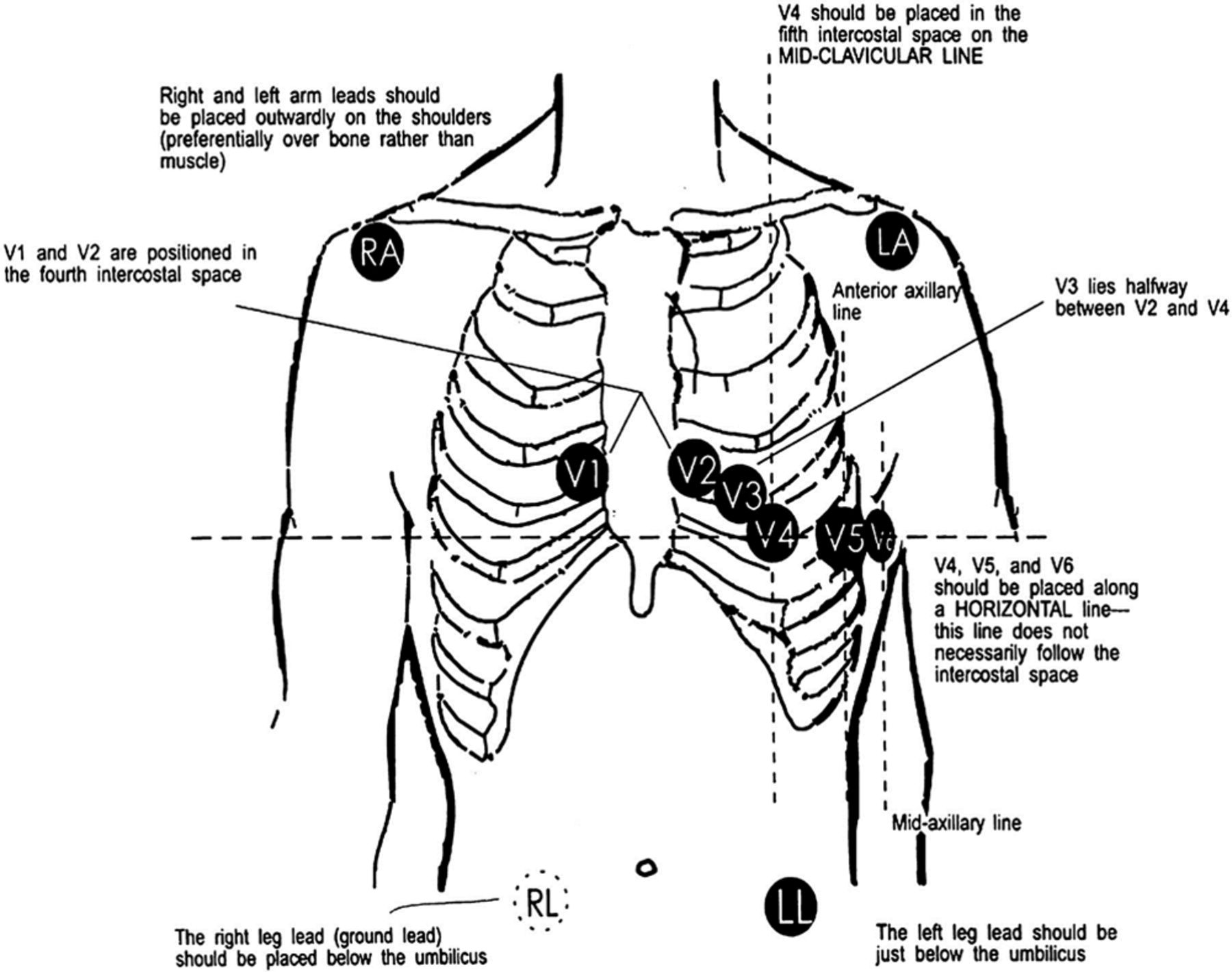 what-does-the-v-stand-for-in-ecg-electrode-names-echemi