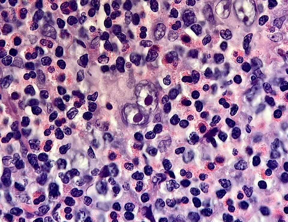 Hodgkin Lymphoma (ReedSternberg cell) staring back at you. Yes, these